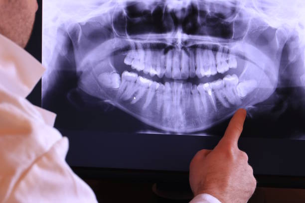 Best Emergency Dental Extractions in Leonardtown, MD